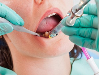 Contemporary Endodontics | Houston Endodontist | Apicoectomy