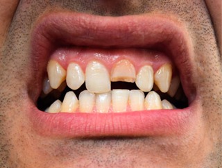 Cracked Teeth