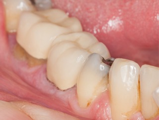 Contemporary Endodontics | Houston Endodontist | Resorption